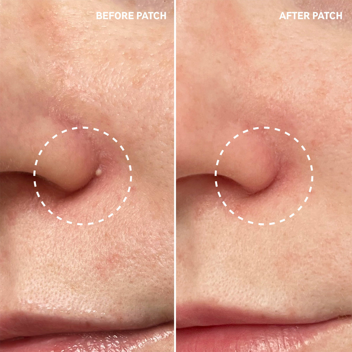 The Inkey List - Hydrocolloid Invisible Pimple Patches Fantastic Look Albania Tirana