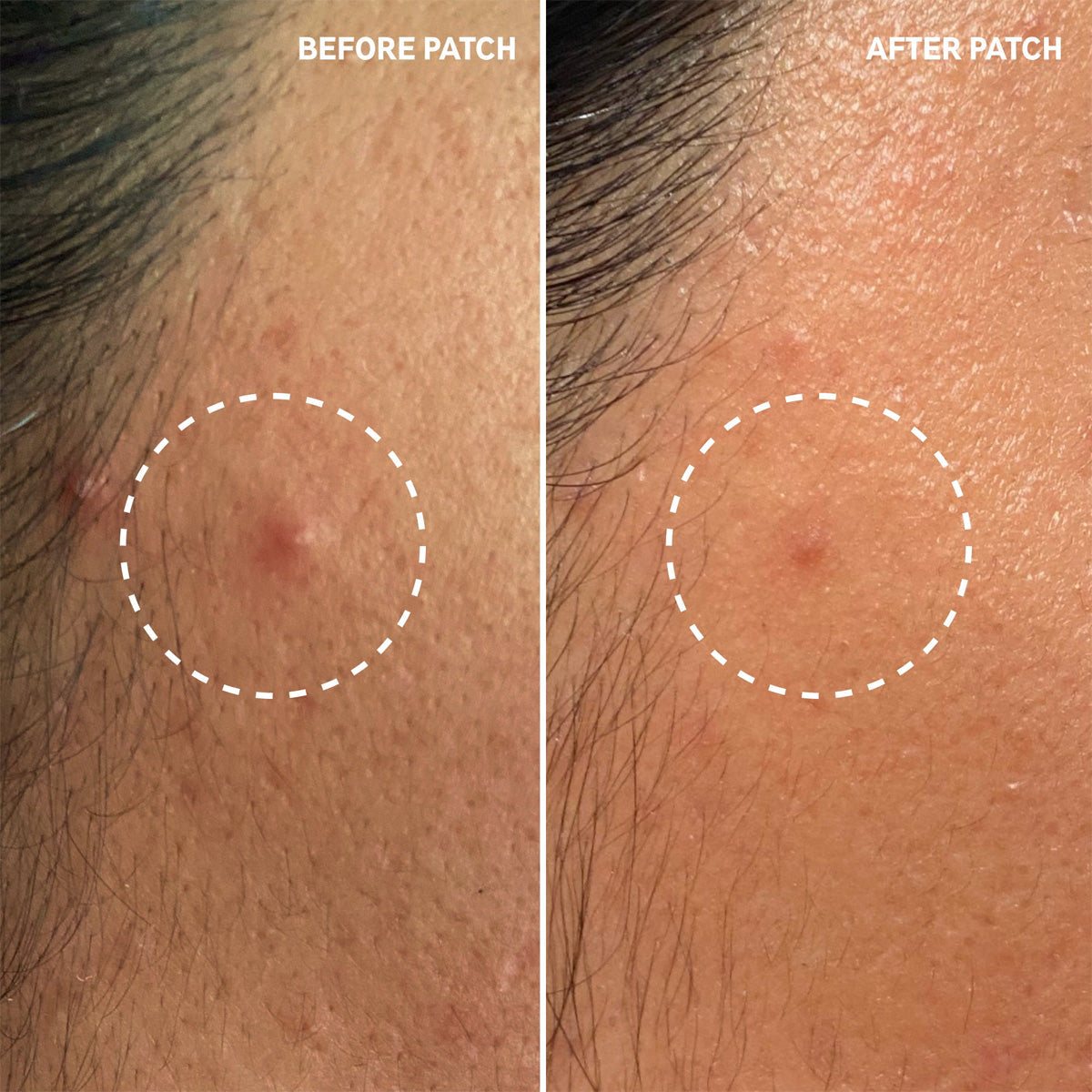 The Inkey List - Hydrocolloid Invisible Pimple Patches Fantastic Look Albania Tirana