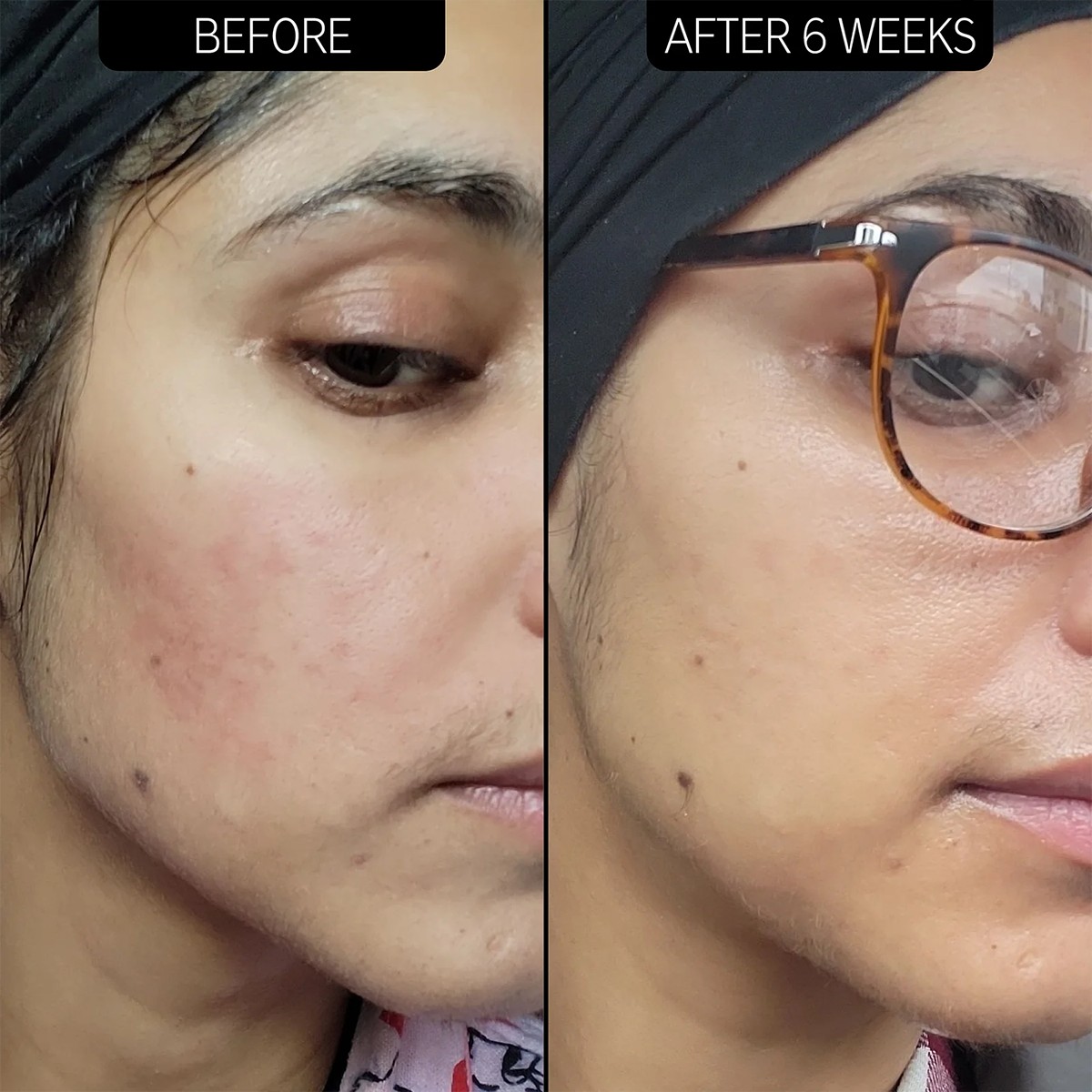 The INKEY List - 10% Azelaic Acid Serum Fantastic Look Albania Tirana
