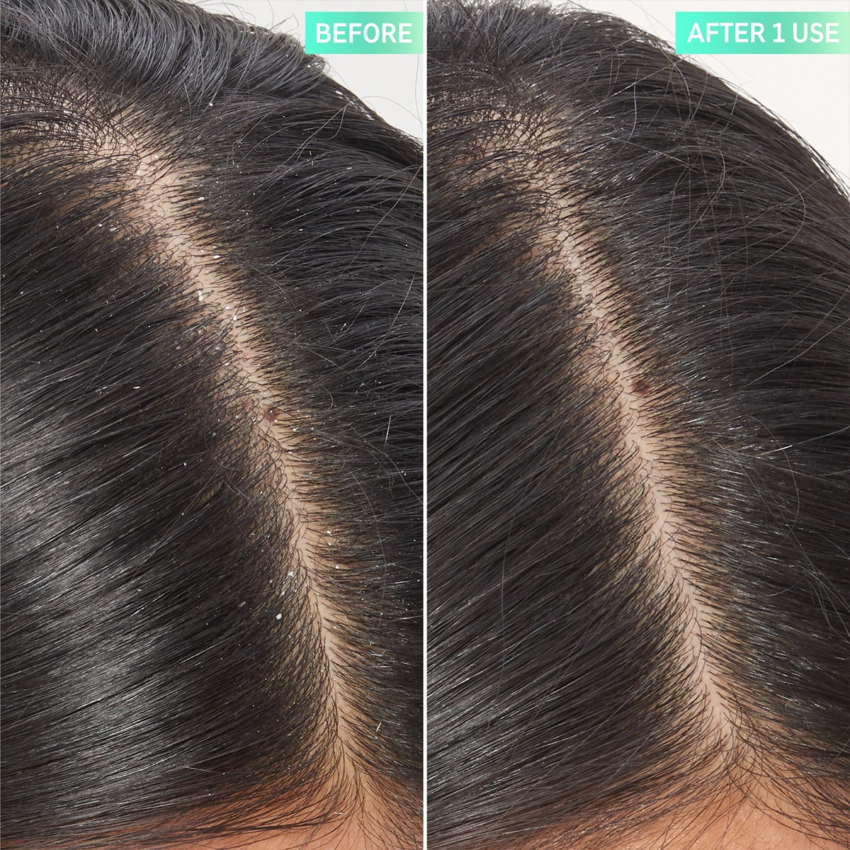 The INKEY List - Salicylic Acid Exfoliating Scalp Treatment Fantastic Look Albania Tirana