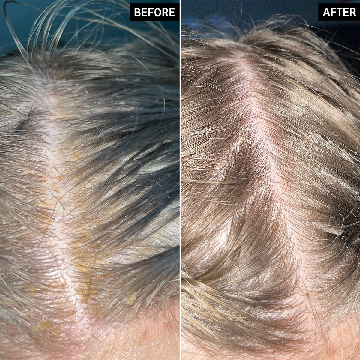 The INKEY List - Salicylic Acid Exfoliating Scalp Treatment Fantastic Look Albania Tirana